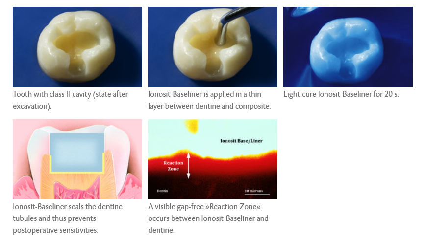 dmg  Ionosit Baseliner procedure